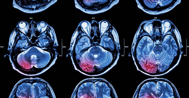 tipuri-de-tumori-cerebrale-neurochirurgie-bucuresti