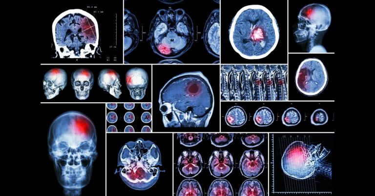 infarct medular