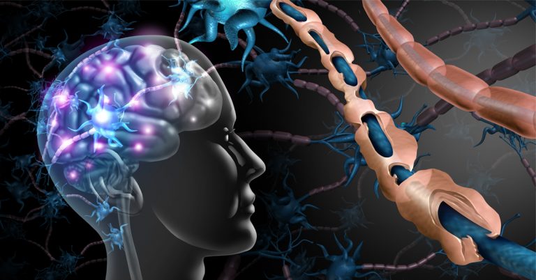 Scleroza in placi sau scleroza multipla, cauze si simptome