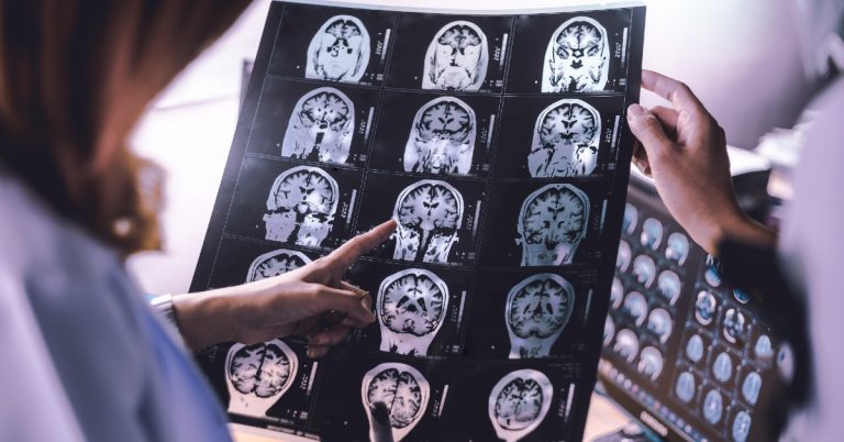 atrofie-cerebrala- imagistica