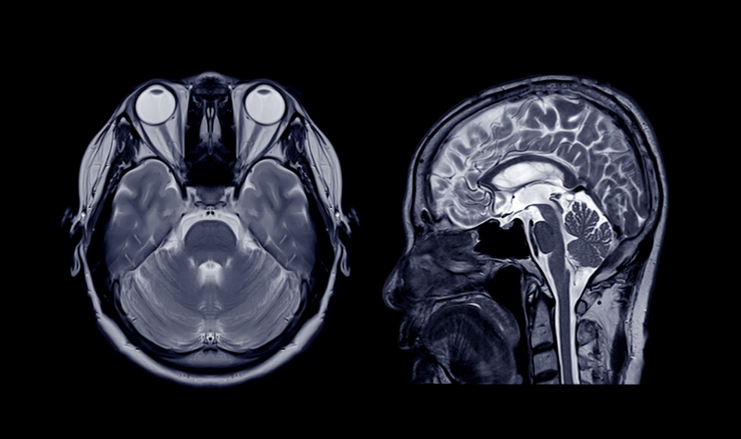RMN Cerebral