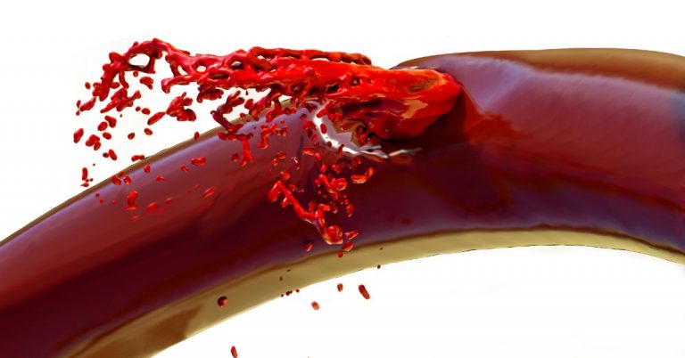 Ruperea unui vas de sange - avc hemoragic